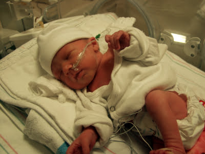 A premature newborn on a respirator in the NICU of a hospital.