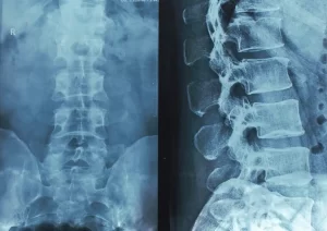 spinal-cord-injury